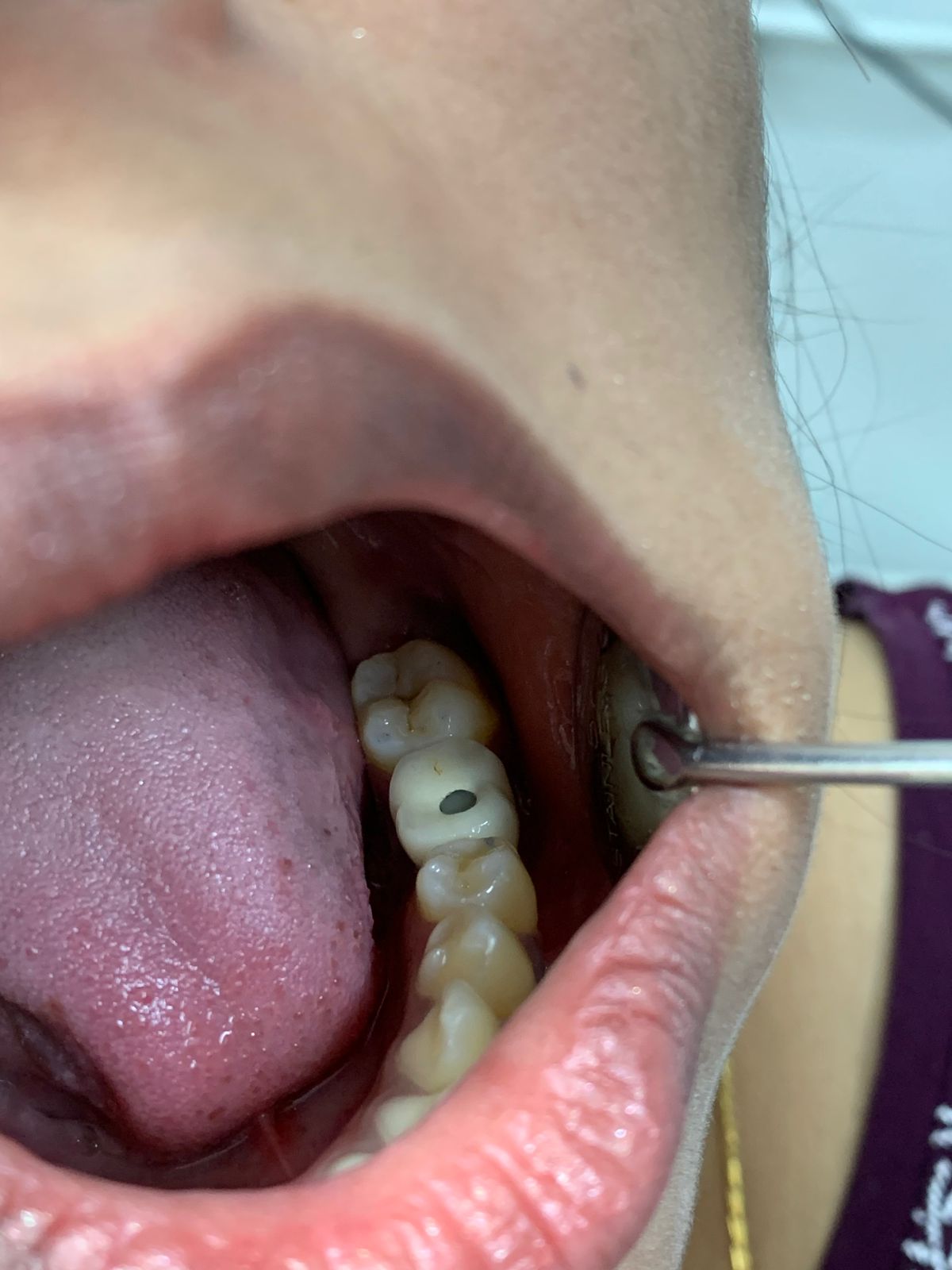 Single tooth replacement with implant after treatment